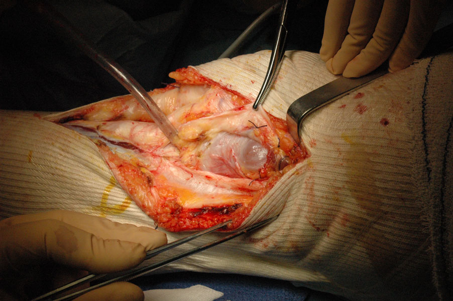 Instabilité rotulienne chirurgie