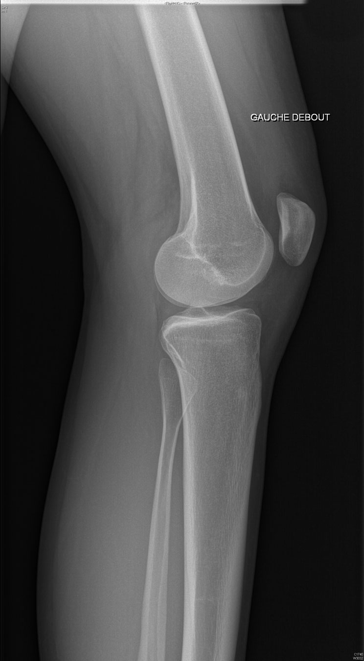 Ligamentoplastie antérieure : Intervention sur le genou - Ortho7