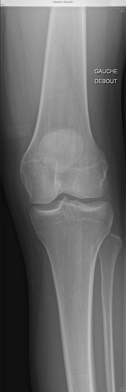 Ligamentoplastie genou opéaration 2