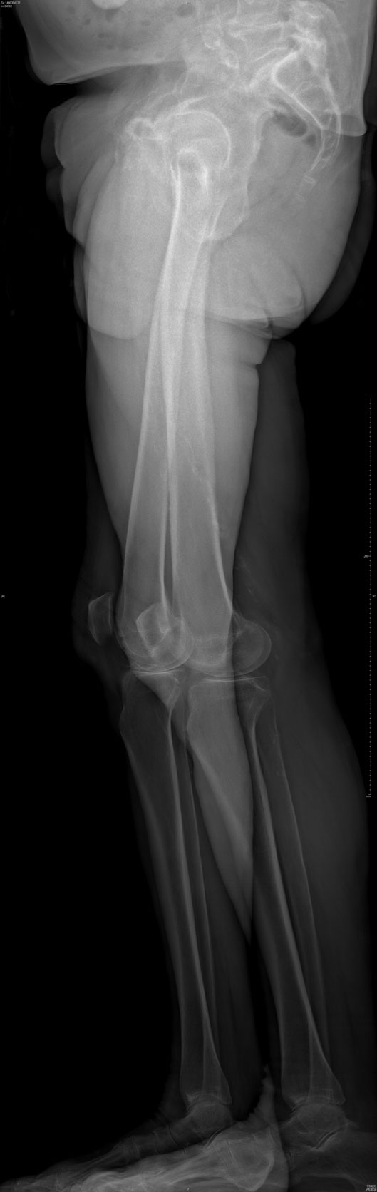 Ostéotomie tibiale de valgisation ortho7