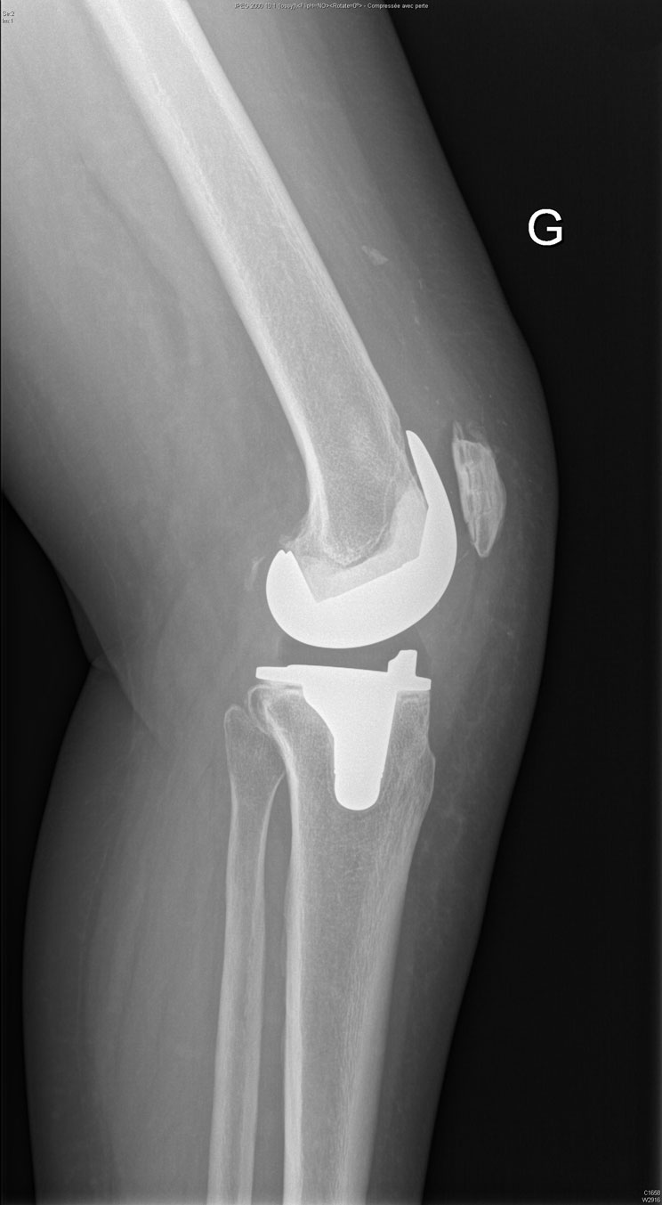 Reprise de prothèse totale du genou pré opératoire