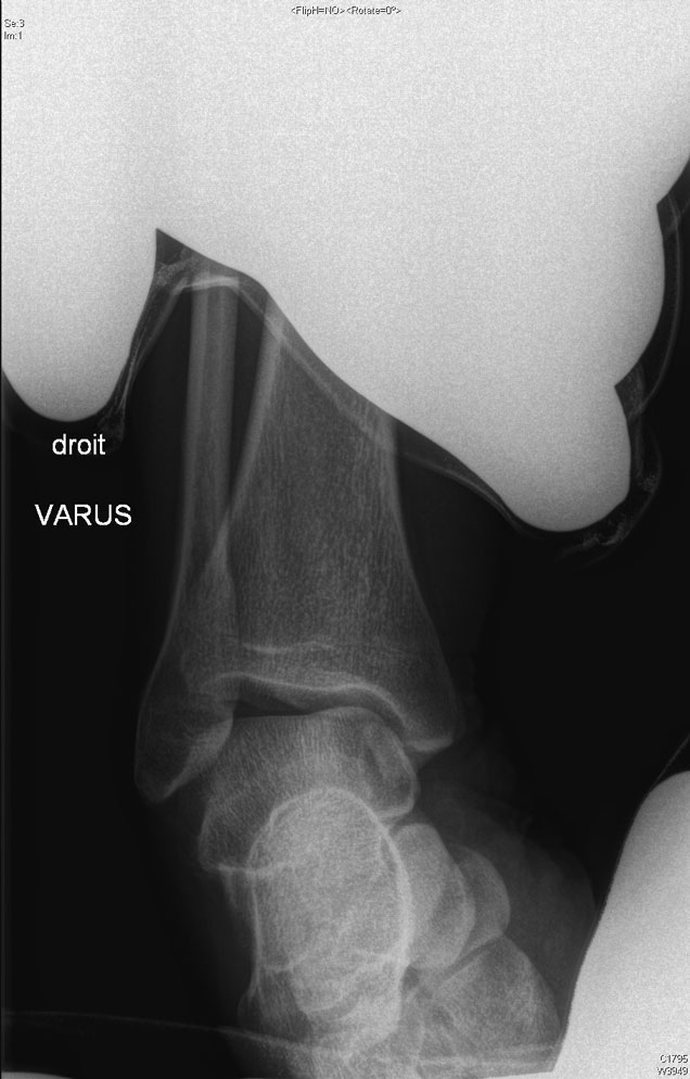 Instabilité ligamentoplastie cheville pré opératoire