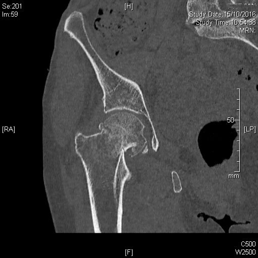 Fracture du col fémoral