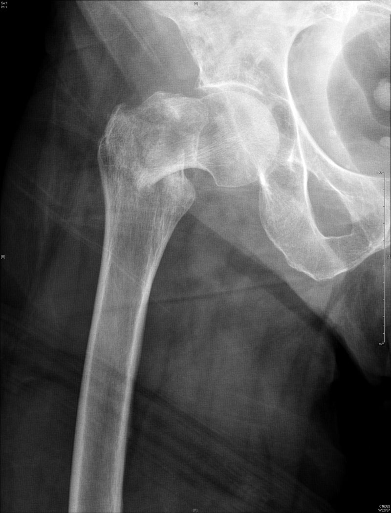 Fracture du col fémoral : Intervention sur les traumatologies - Ortho7