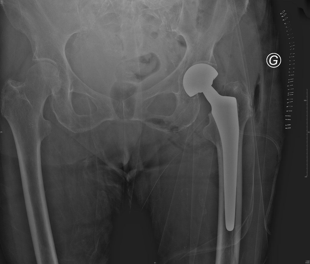 Fracture du col fémoral Post opératoire