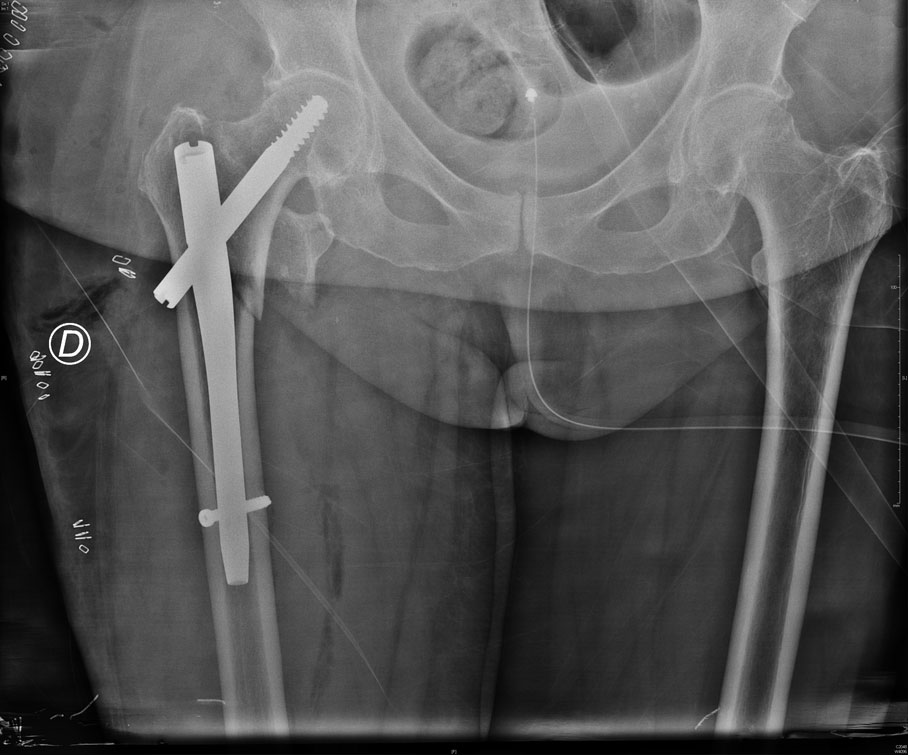 Fracture du massif trochanterien 2