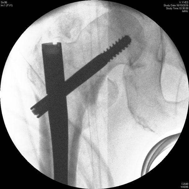 Fracture du massif trochanterien 4