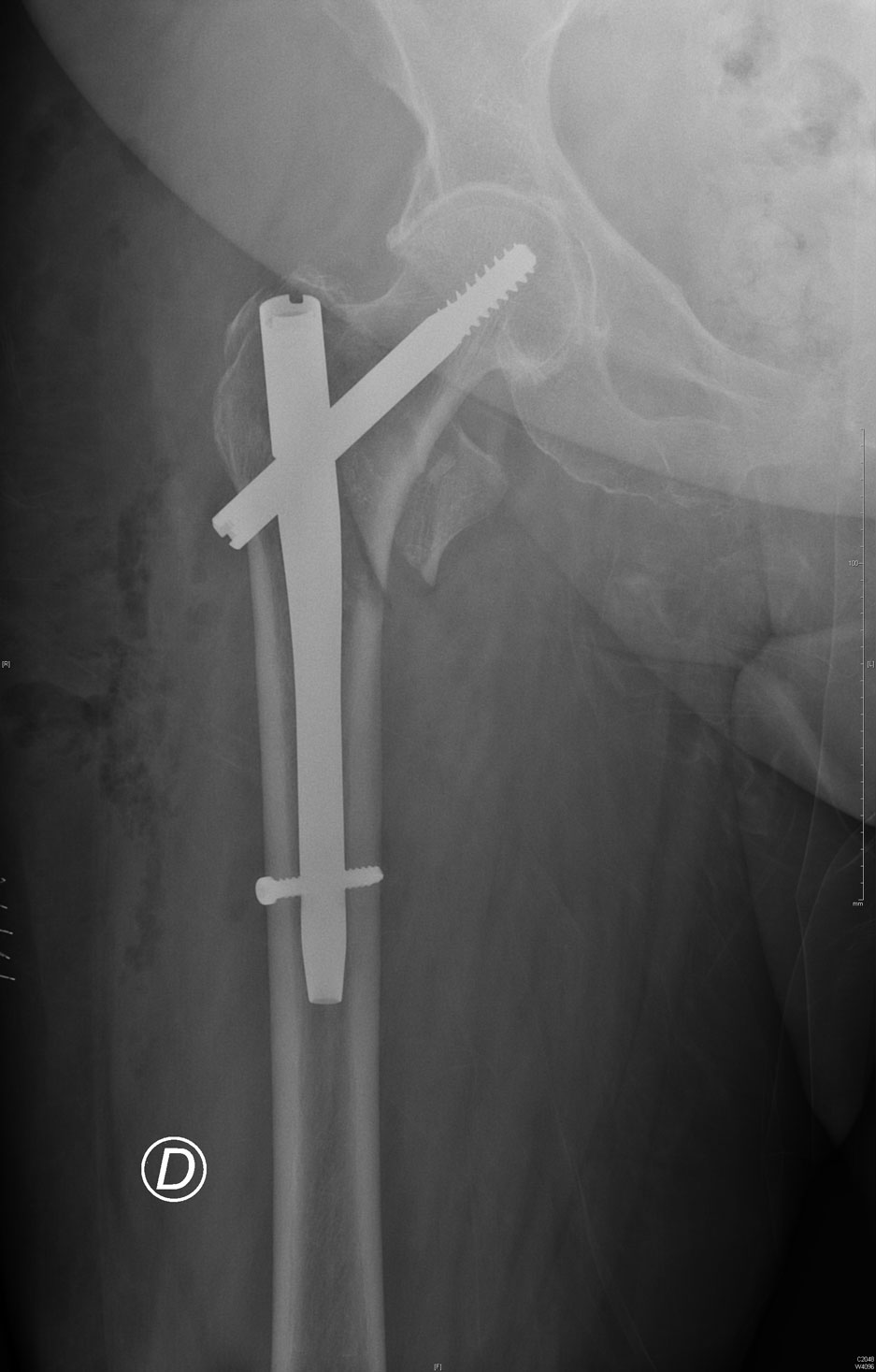 Fracture du massif trochanterien Gama