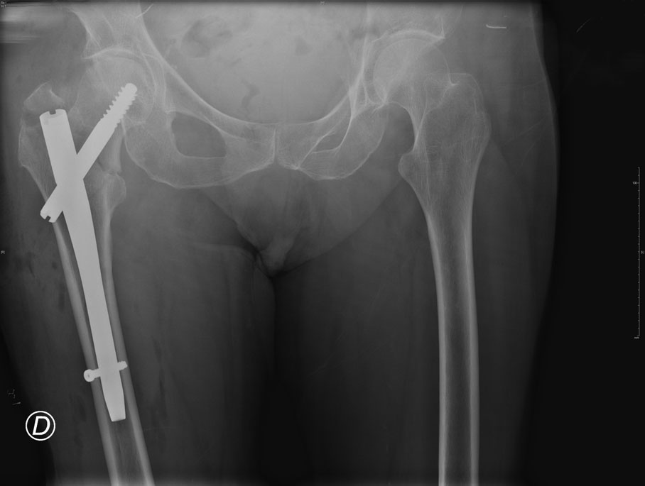 Fracture du massif trochanterien Gama 2