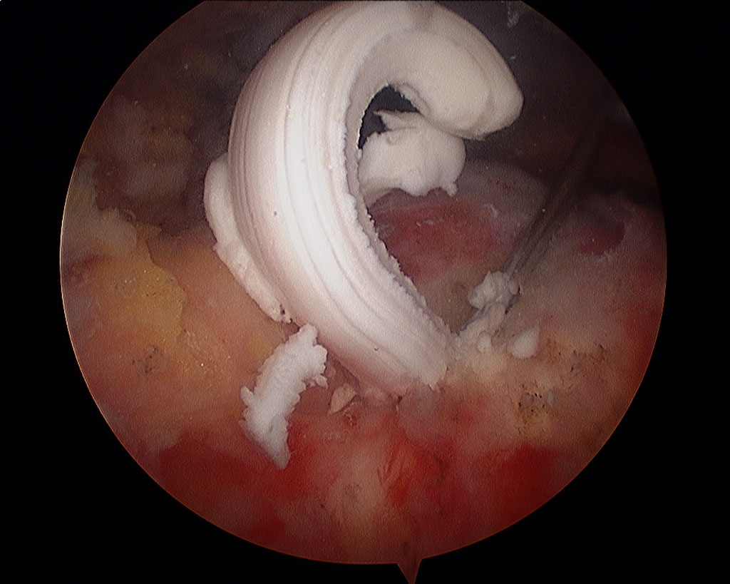 Calcification coiffe des rotateurs